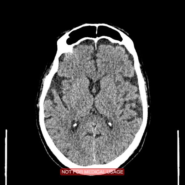 File:Artery of Percheron infarction (Radiopaedia 28679-28967 Axial non-contrast 63).jpg