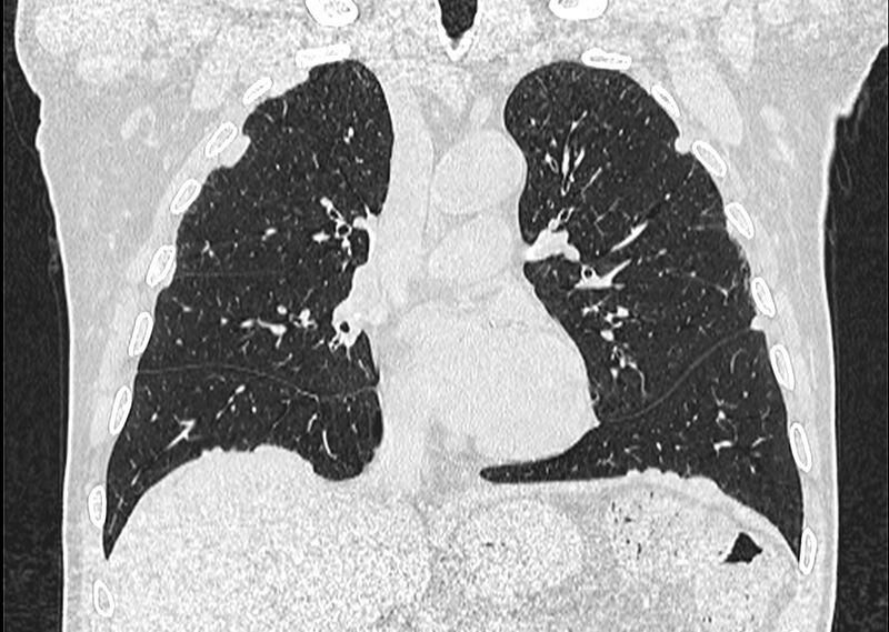 File:Asbestos pleural placques (Radiopaedia 57905-64872 Coronal lung window 125).jpg