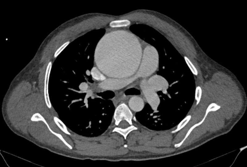 File:Ascending aortic aneurysm (Radiopaedia 86279-102297 C 23).jpg