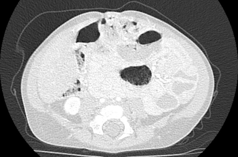 File:Asplenia syndrome (Radiopaedia 73083-83792 Axial lung window 110).jpg