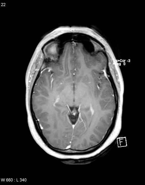 File:Astroblastoma (Radiopaedia 39792-42218 Axial T1 C+ 21).jpg