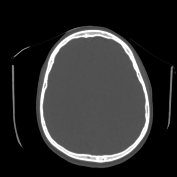 File:Asymptomatic occipital spur (Radiopaedia 87753-104201 Axial bone window 133).jpg
