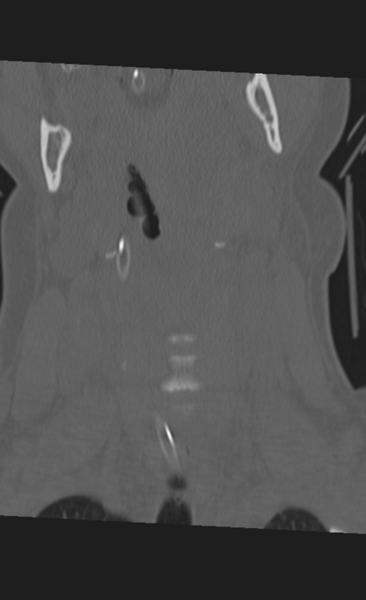File:Atlanto-occipital dissociation (Radiopaedia 33848-35013 Coronal bone window 5).png