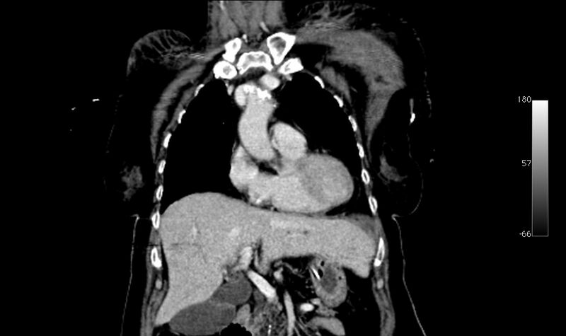 File:Atypical dissection of the thoracic aorta (Radiopaedia 10975-78320 B 4).jpg