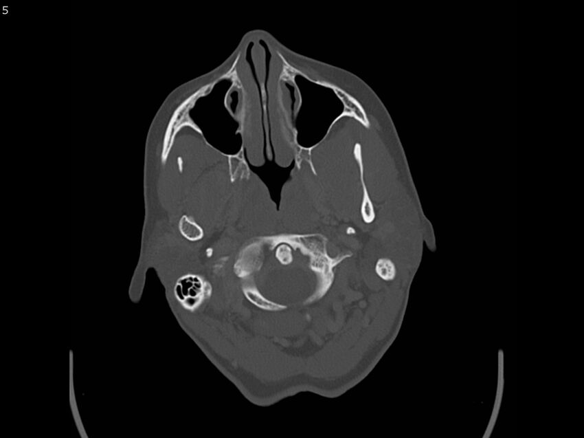 Atypical meningioma - intraosseous (Radiopaedia 64915-73867 Axial C+ bone window 5).jpg