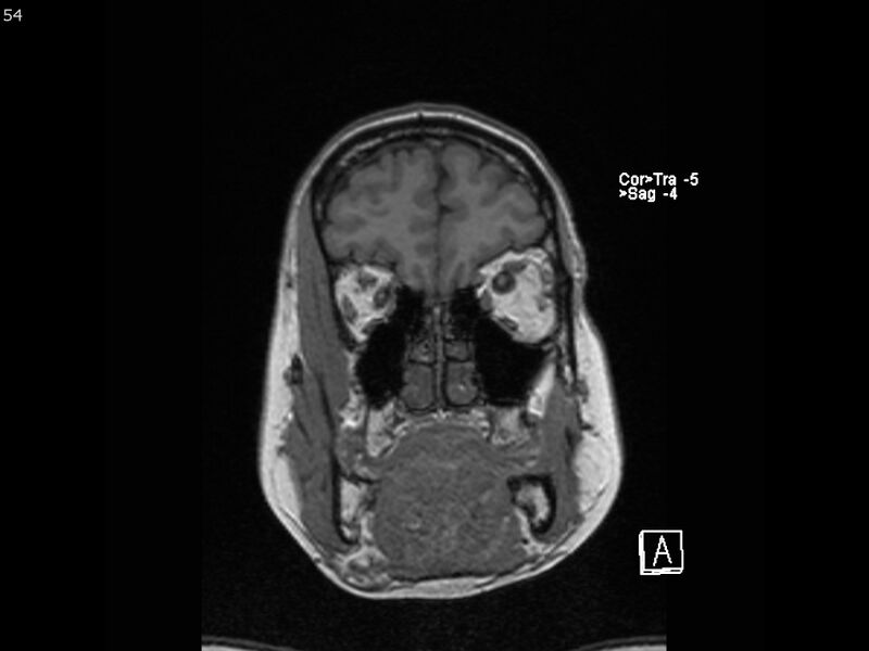 File:Atypical meningioma - intraosseous (Radiopaedia 64915-74572 Coronal T1 54).jpg