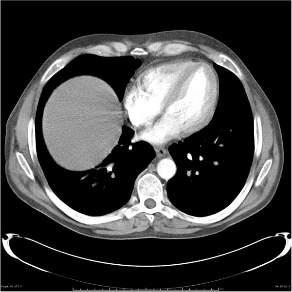 File:Atypical pneumonia - Q fever (Radiopaedia 21993-21989 C+ arterial phase 34).jpg
