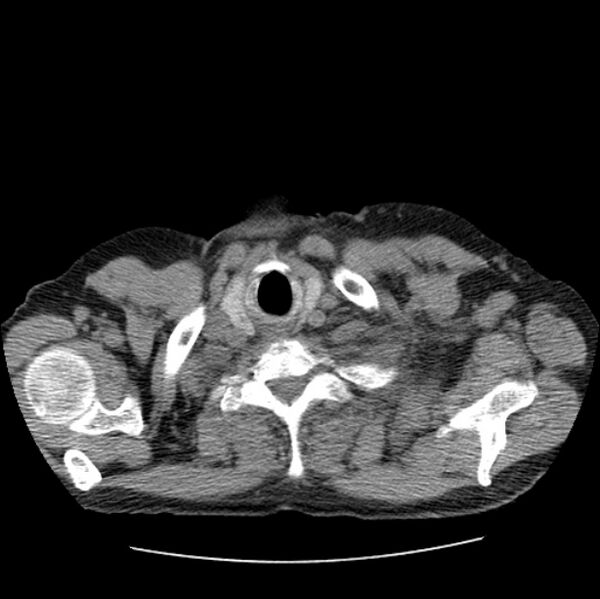 File:Autosomal dominant polycystic kidney disease (Radiopaedia 27851-28094 Axial non-contrast 1).jpg
