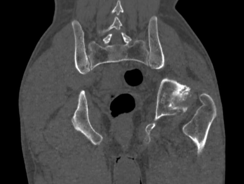 File:Avascular necrosis of the left hip (Radiopaedia 75068-86125 Coronal bone window 73).jpg