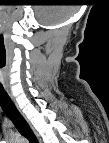 File:Axis peg fracture (type 3) and atlas lateral mass (type 4) fracture (Radiopaedia 37474-39324 D 45).png