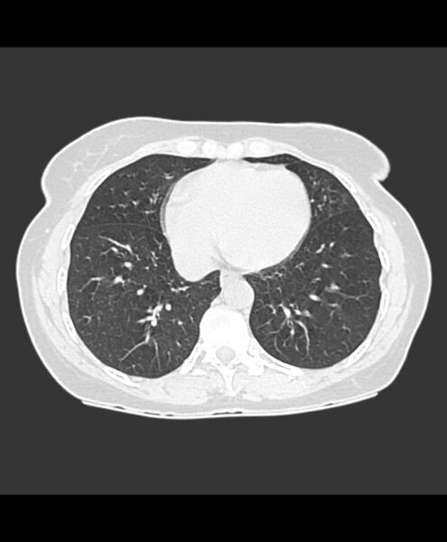 File:Azygos fissure and azygos lobe (Radiopaedia 41841-44832 Axial lung window 5).jpg