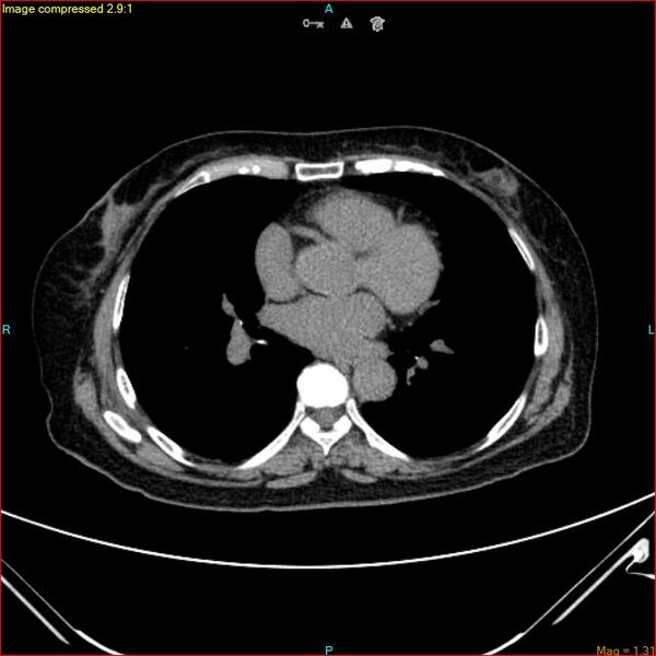 File:Azygos vein aneurysm (Radiopaedia 77824-90130 A 34).jpg