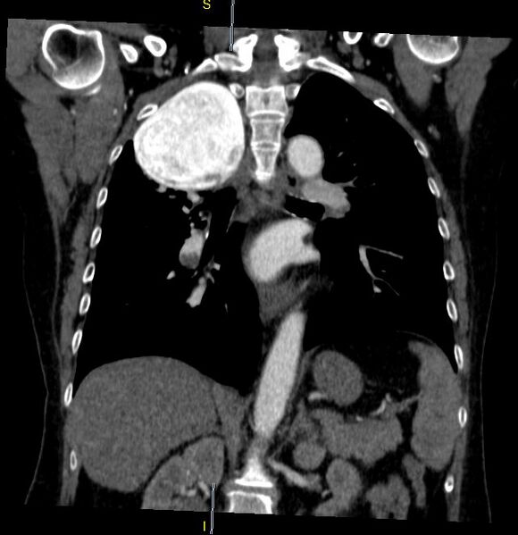 File:Azygos vein aneurysm (Radiopaedia 77824-90130 C 21).JPG