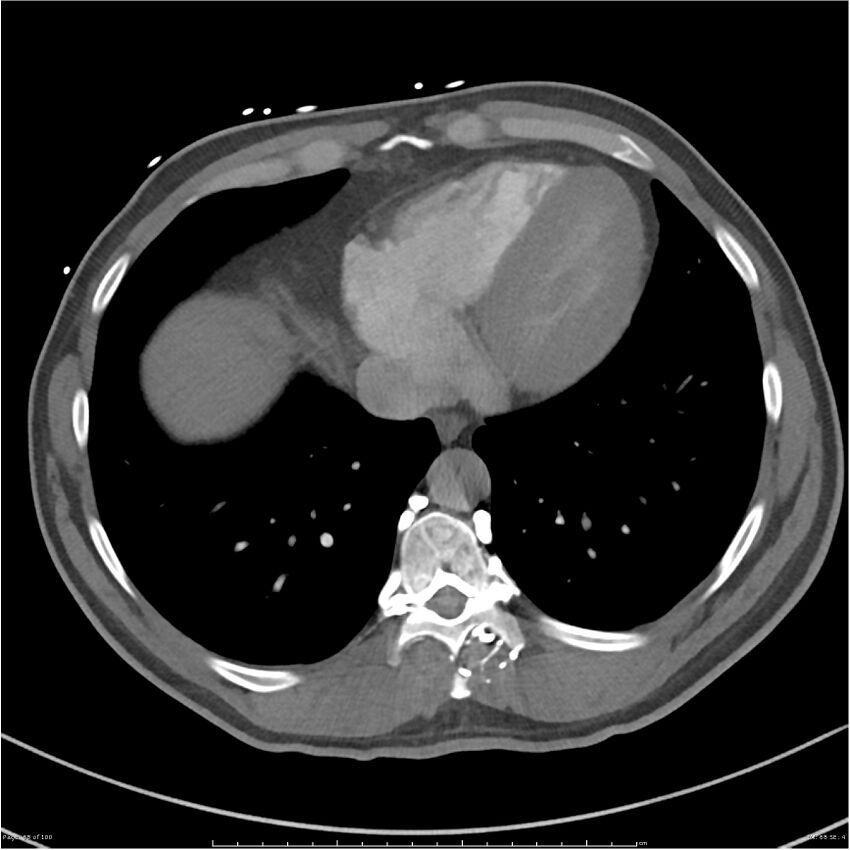 Azygos venous system anatomy (CT pulmonary angiography) (Radiopaedia 25928-26077 Axial C+ CTPA 68).jpg