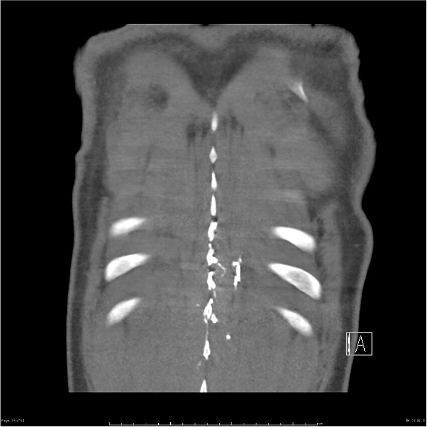 Azygos venous system anatomy (CT pulmonary angiography) (Radiopaedia 25928-26077 Coronal C+ CTPA 74).jpg