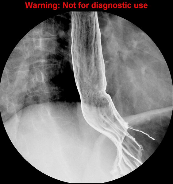 File:Barrett esophagus (Radiopaedia 44421-48075 A 4).jpg