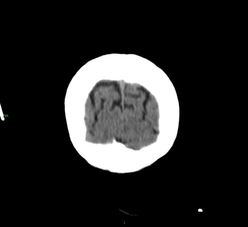 Basal ganglia hemorrhage (Radiopaedia 58790-66024 Coronal non-contrast 6).jpg