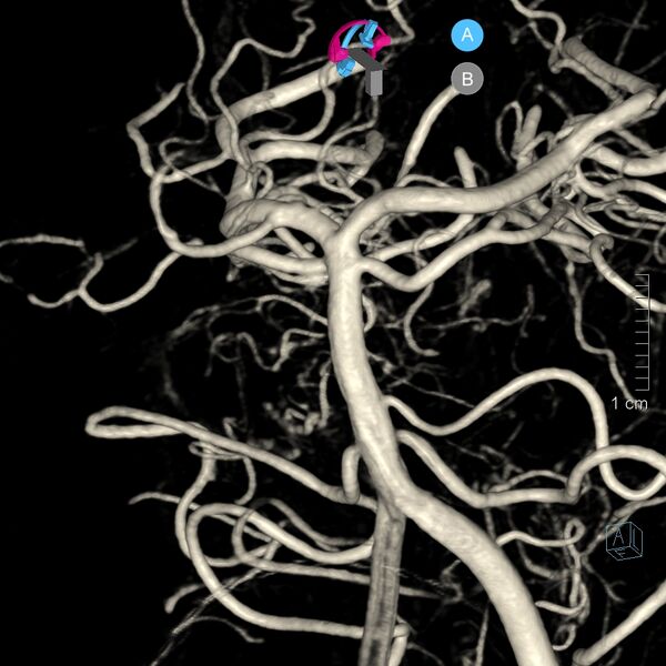 File:Basilar artery perforator aneurysm (Radiopaedia 82455-97734 3D view left VA 36).jpg