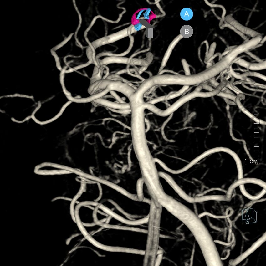 Basilar artery perforator aneurysm (Radiopaedia 82455-97734 3D view left VA 36).jpg