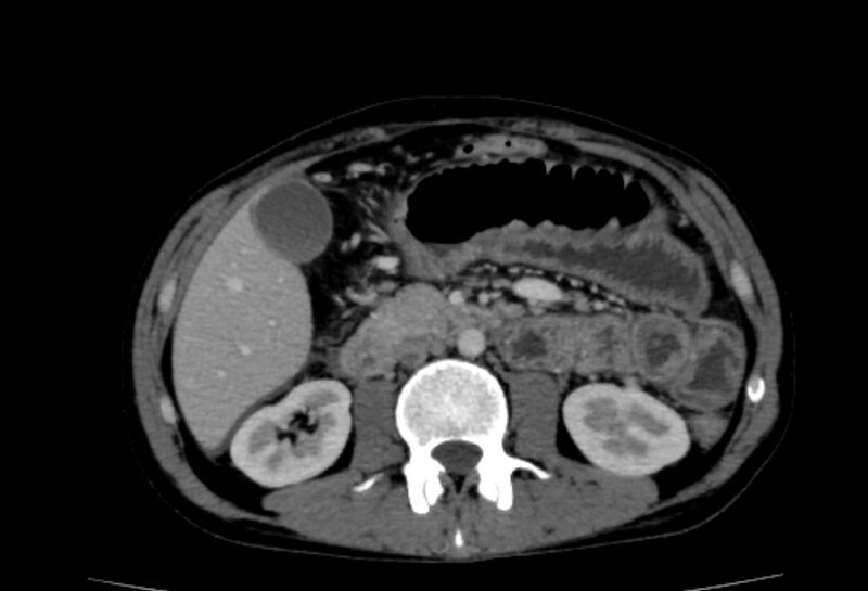 File:Behçet's disease- abdominal vasculitis (Radiopaedia 55955-62570 A 35).jpg