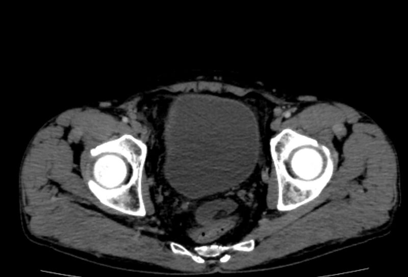 File:Behçet's disease- abdominal vasculitis (Radiopaedia 55955-62570 A 84).jpg