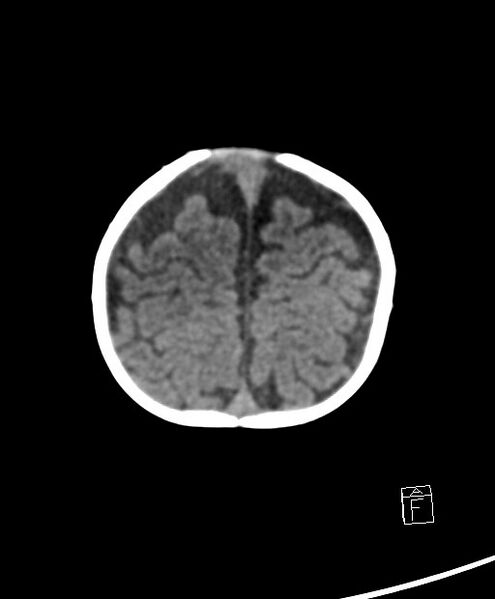 File:Benign enlargement of subarachnoid spaces in infancy (BESS) (Radiopaedia 87459-103795 Axial non-contrast 13).jpg