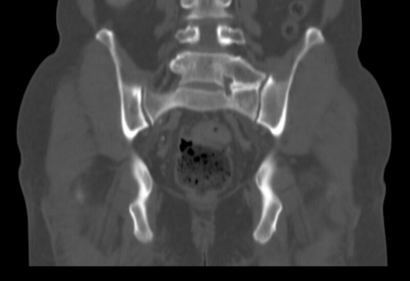 File:Bertolotti syndrome (Radiopaedia 58974-66235 Coronal bone window 14).jpg