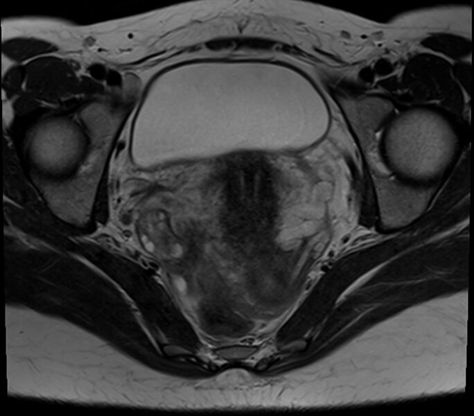 File:Bicornuate uterus (Radiopaedia 71214-81511 Axial T2 14).jpg