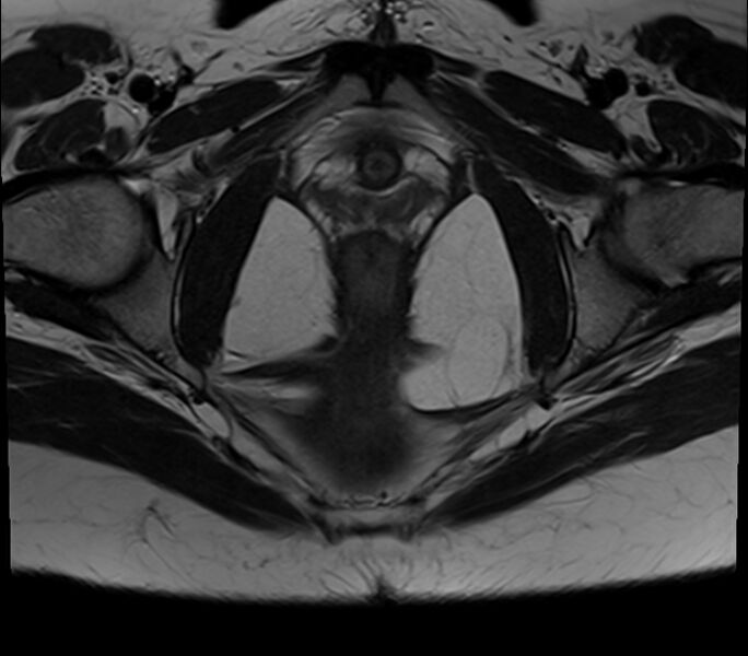 File:Bicornuate uterus (Radiopaedia 71214-81511 Axial T2 7).jpg