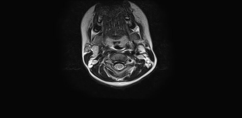 File:Bilateral Sprengel deformity with Klippel-Feil syndrome (Radiopaedia 66395-75650 Axial T2 9).jpg