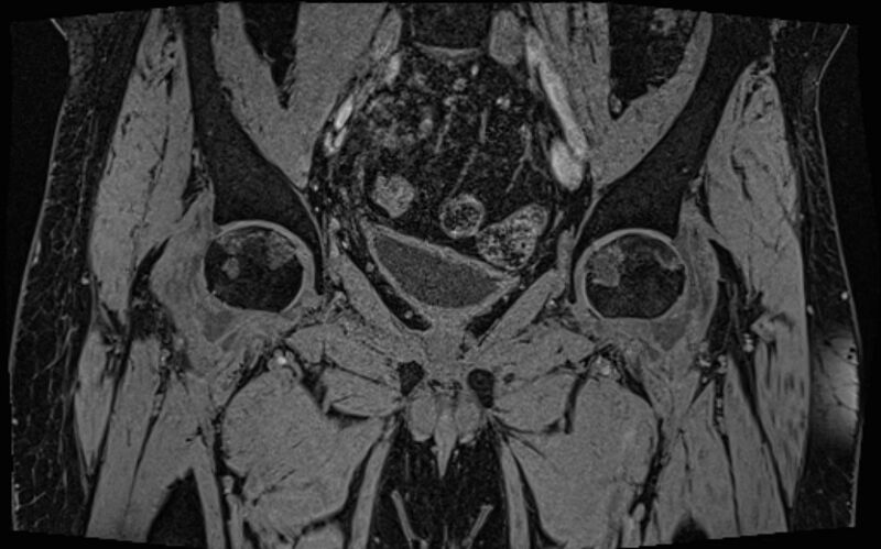 File:Bilateral avascular necrosis of femoral head (Radiopaedia 77116-89078 Coronal T2 we 54).jpg