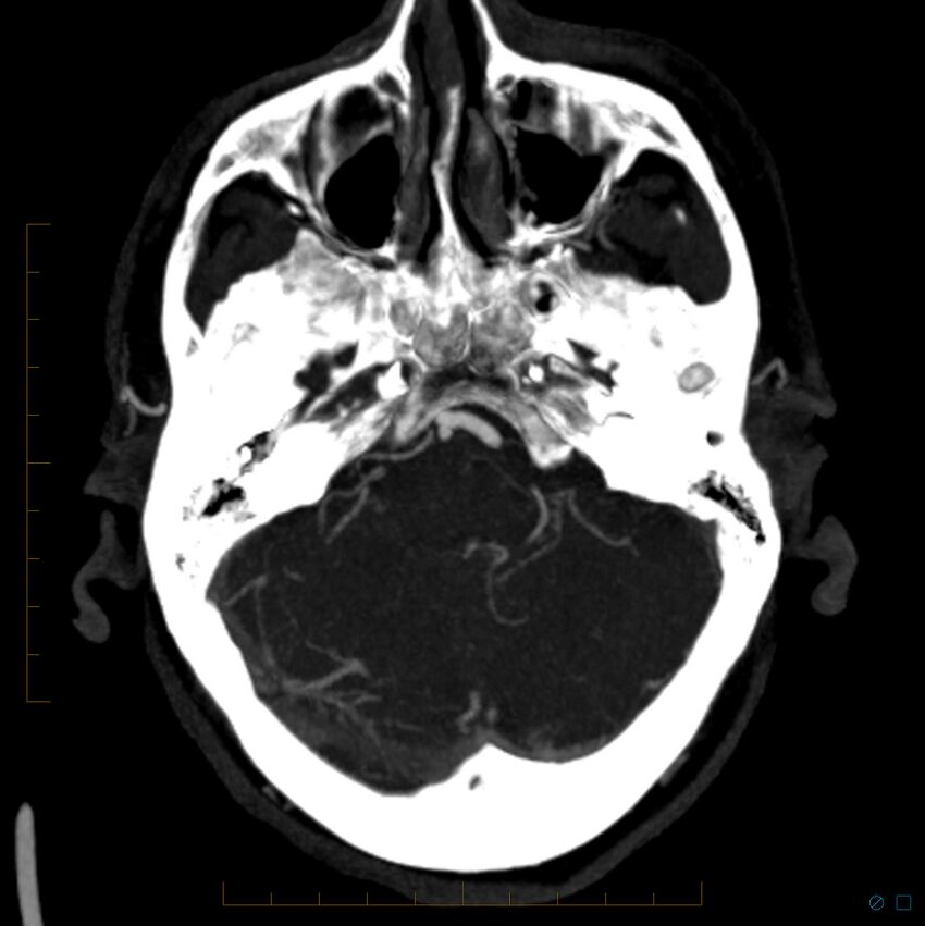 Bilateral chronic common carotid occlusion (Radiopaedia 50849-56362 D 23).jpg