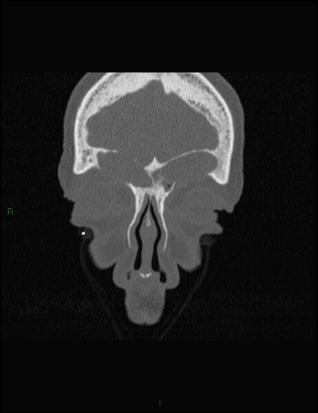 File:Bilateral frontal mucoceles (Radiopaedia 82352-96454 Coronal 68).jpg