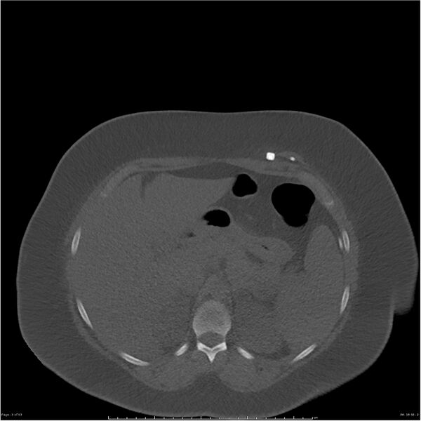 File:Bilateral lumbar ribs (Radiopaedia 25862-26010 bone window 3).jpg