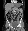 Bilateral ovarian mature cystic teratomas (Radiopaedia 79373-92457 B 23).jpg