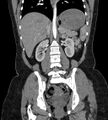 Bilateral ovarian mature cystic teratomas (Radiopaedia 79373-92457 B 51).jpg