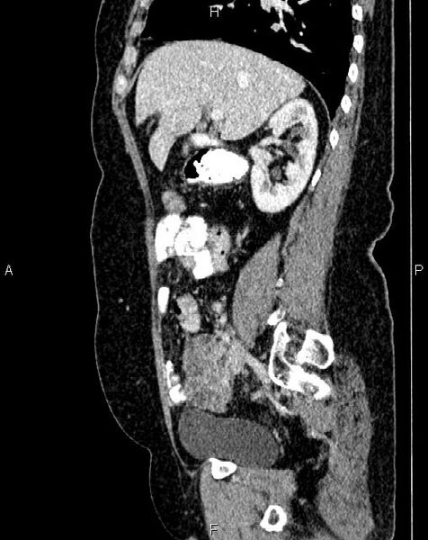 File:Bilateral ovarian serous cystadenocarcinoma (Radiopaedia 86062-101989 E 27).jpg