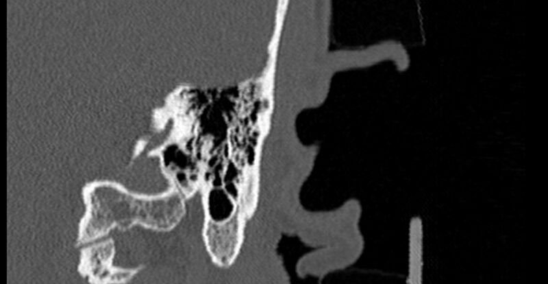 File:Bilateral temporal bone fractures (Radiopaedia 29482-29970 B 71).jpg
