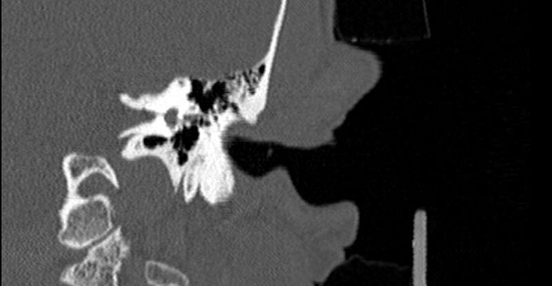 File:Bilateral temporal bone fractures (Radiopaedia 29482-29970 Coronal 207).jpg