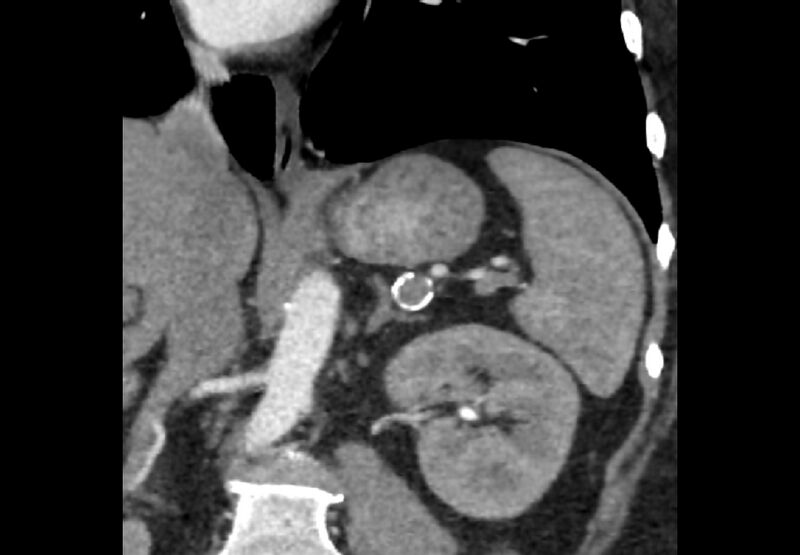 File:Bilateral urolithiasis with incidentally detected splenic artery aneurysm and left inferior vena cava (Radiopaedia 44467-48127 Ob. Cor. C+ Art. 7).jpg