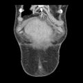 Biliary necrosis - liver transplant (Radiopaedia 21876-21846 C 1).jpg