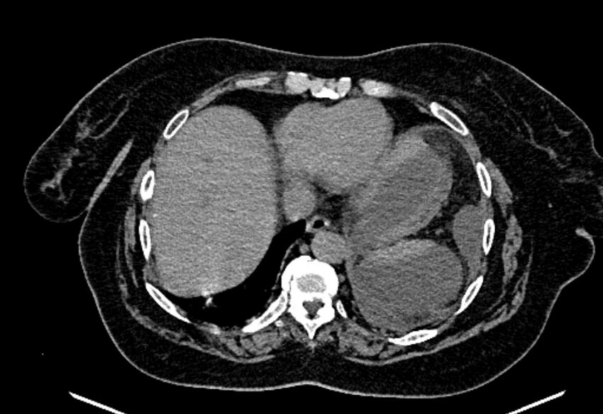 Biliary pancreatitis (Radiopaedia 72289-82823 Axial non-contrast 37).jpg