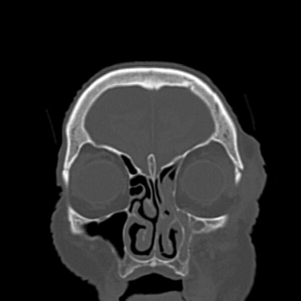 File:Biparietal osteodystrophy (Radiopaedia 46109-50463 Coronal bone window 23).jpg
