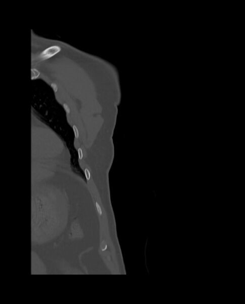 File:Bizarre parosteal osteochondromatous proliferation (Radiopaedia 84221-99501 Coronal bone window 1).jpg