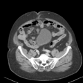 Bladder papillary urothelial carcinoma (Radiopaedia 48119-52951 Axial 42).png