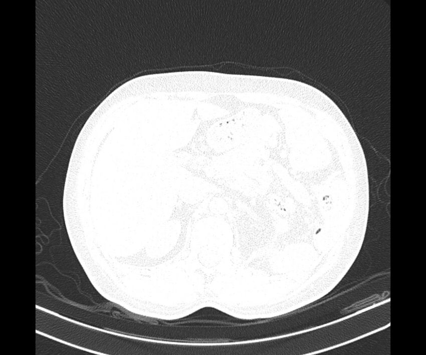 Bochdalek hernia - adult presentation (Radiopaedia 74897-85925 Axial lung window 47).jpg