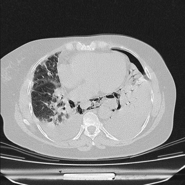 File:Boerhaave syndrome (Radiopaedia 45644-49799 Axial lung window 78).jpg