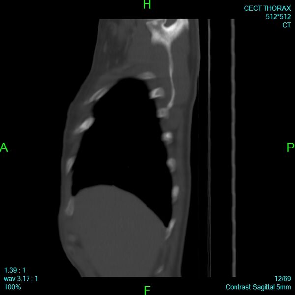 File:Bone metastases from lung carcinoma (Radiopaedia 54703-60937 Sagittal bone window 12).jpg