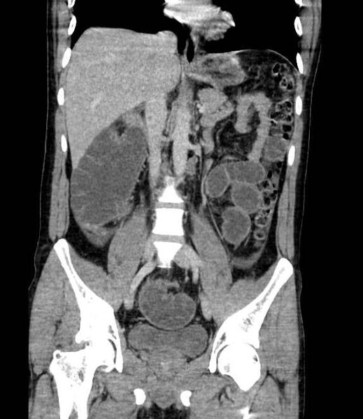 File:Bowel obstruction from colon carcinoma (Radiopaedia 22995-23028 C 40).jpg
