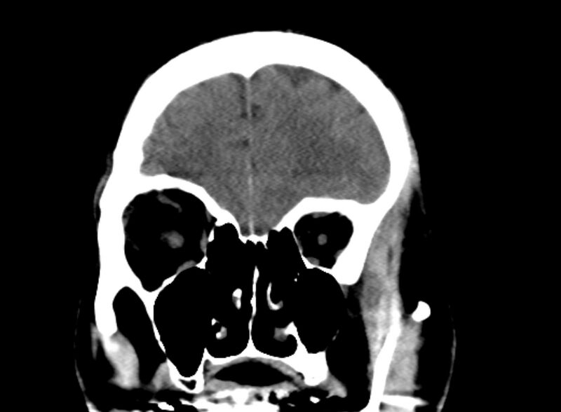 File:Brain abscess complicated by intraventricular rupture and ventriculitis (Radiopaedia 82434-96575 Coronal non-contrast 2).jpg